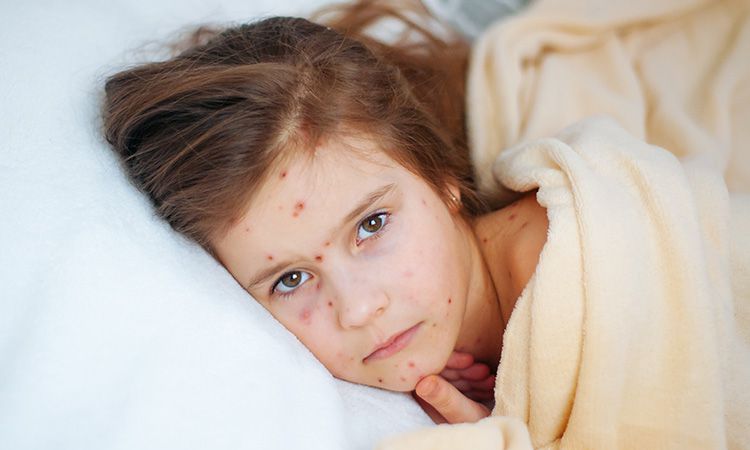 Zakażenie odrą - przyczyny, objawy, diagnostyka, leczenie