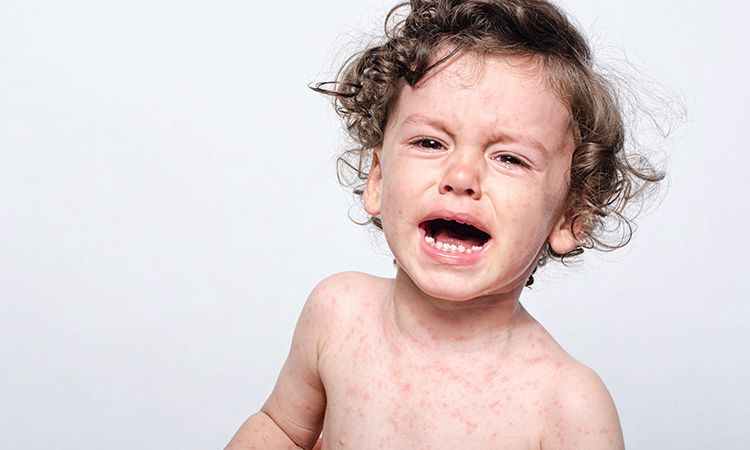 Objawy różyczki, profilaktyka, diagnostyka i leczenie - u dzieci i dorosłych