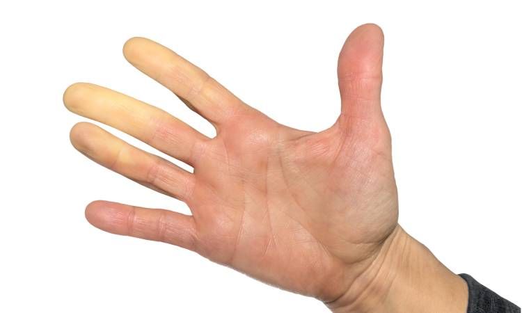 Choroba Raynauda – przyczyny, objawy i sposoby leczenia