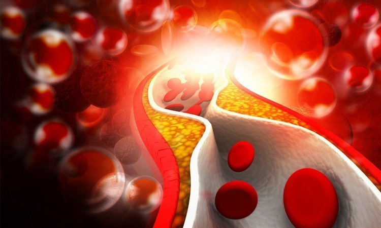 Podwyższony cholesterol - objawy i leczenie