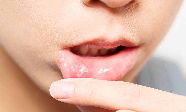 Afty – przyczyny występowania i sposoby leczenia
