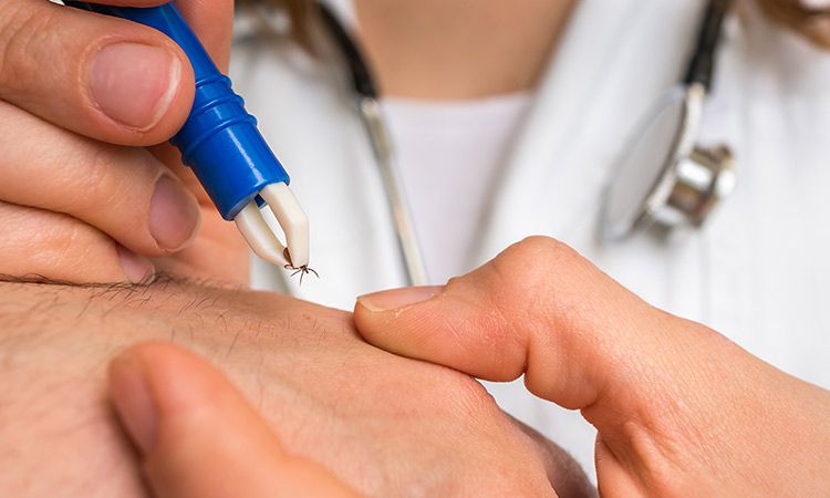 Jak bezpiecznie usunąć kleszcza? Sprawdzone metody